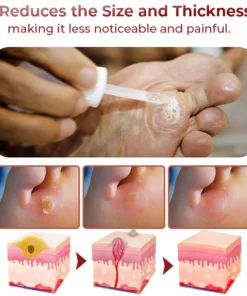 GFOUK™ Foot Corn Removal Extra Strengthen Gel
