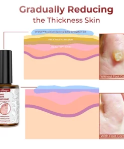 GFOUK™ Foot Corn Removal Extra Strengthen Gel