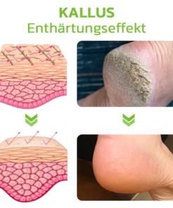 GFOUK™ IHerbal Fuß Schwielen und Hühneraugen Entfernung Soak