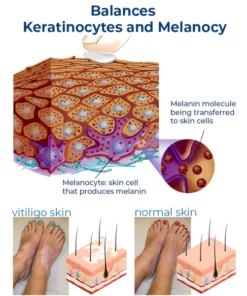 GFOUK™ Vitiligo-Therapie-Creme