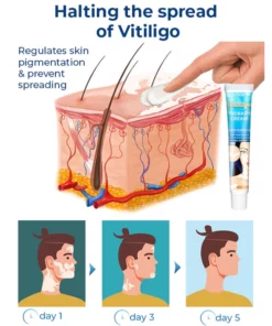 GFOUK™ Vitiligo-Therapie-Creme