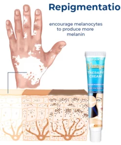 GFOUK™ Vitiligo-Therapie-Creme