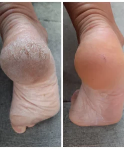 KK™ FX Foot Callus Removal Spray