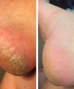 KK™ FX Foot Callus Removal Spray