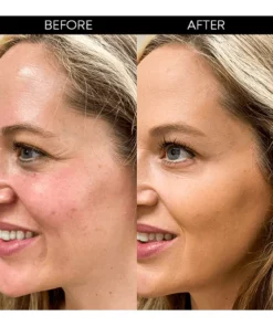 Korean Protein Lifting Threading Set