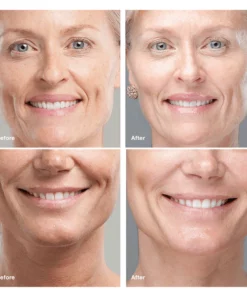 Korean Protein Lifting Threading Set