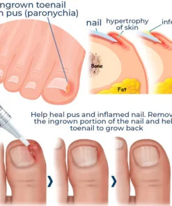 LEFUN Removal Paronychia Gel