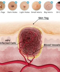 MiracleTag™ MicroDarts SkinTAG Blemish Patches