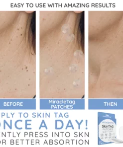 MiracleTag™ MicroDarts SkinTAG Blemish Patches