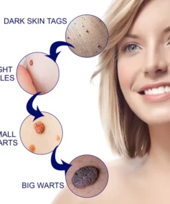 OUHOE™ Tags & Moles Remover