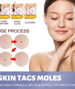 OUHOE™ Tags & Moles Remover