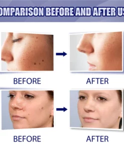 OUHOE™ Tags & Moles Remover