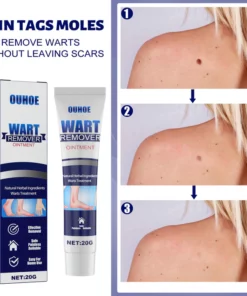 OUHOE™ Tags & Moles Remover