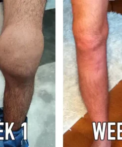 Oveallgo™ BZ New Zealand Bee Venom Professional Treatment Gel