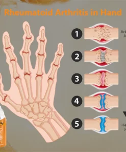 Oveallgo™ Bee Venom Joint & Bone Therapy Spray