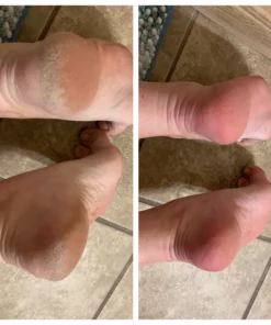 Oveallgo™ FX Foot Callus Removal Spray