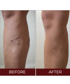 Oveallgo™ Varicose Veins Relief Cream