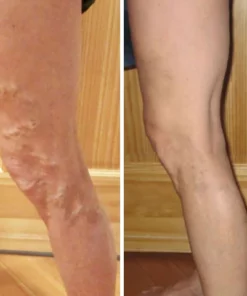 Oveallgo™ VeinCare MagAcupoint Reflexology Insole