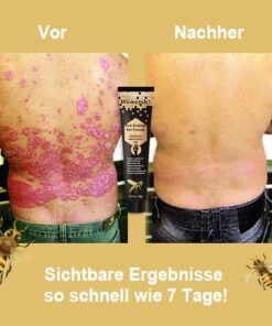 Alternative view of SunKissed™ New Zealand Bee Venom Psoriasis Treatment Gel