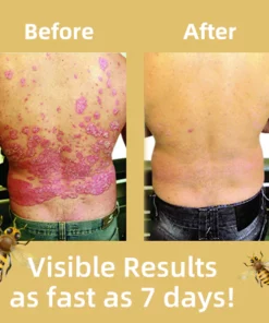 VitalDerm™ Bees Venom Psoriasis Treatment Cream