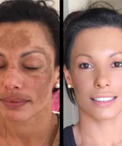 Oveallgo™ProX Cleansing Lotion for Acne & Spots & Acanthosis Nigricans