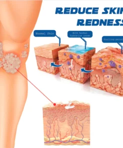 Alternative view of ATTDX Psoriasis Treatment BeeVenom Cream