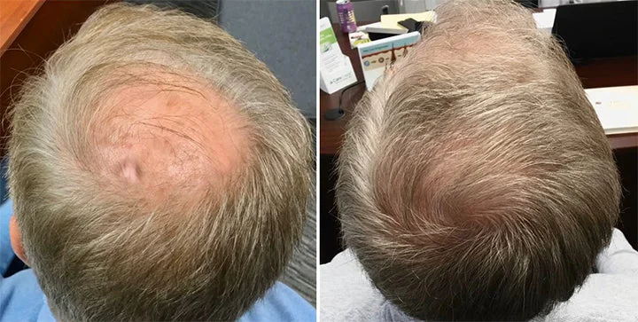 Biancat™ Hair DensityBoost Capsules