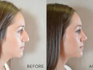 Alternative view of Bomgx™ Nasenkorrektur-Serum