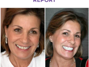 CC™ Deluxe Herbal Teeth Whitening Mousse
