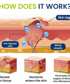 Dermafy™ Skin Tags & Mole Remover