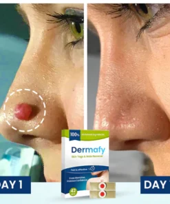 Dermafy™ Skin Tags & Mole Remover