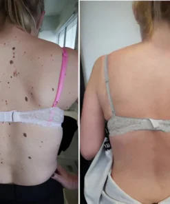 Dermafy™ Skin Tags & Mole Remover