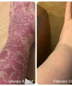 Dobshow™ Bee Venom Psoriasis Relief Cream