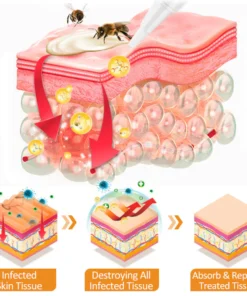 Dobshow™ Bee Venom Psoriasis Relief Cream