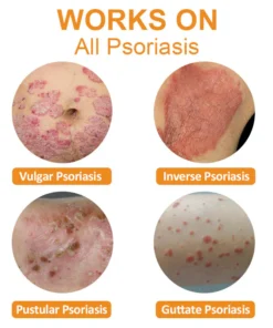 Dobshow™ Bee Venom Psoriasis Relief Cream