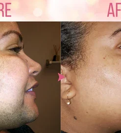 Dobshow™ Beeswax Hair Removal Mousse for Men and Women