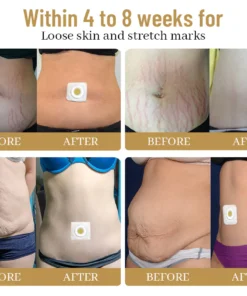 Dobshow™ slimming patches with bee venom