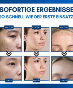 ElektroDerm™ Hautanhänger-Behandlungsstift