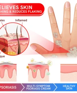 Fivfivgo™ Bee Venom Multi-Symptom Psoriasis Cream