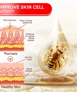 Fivfivgo™ Bee Venom Multi-Symptom Psoriasis Cream