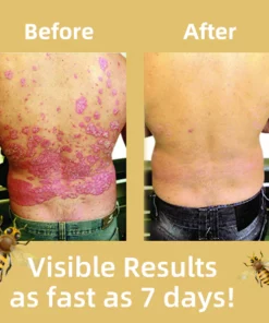 Fivfivgo™ Bee Venom Psoriasis Treatment Cream