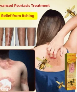 Fivfivgo™ Bee Venom Psoriasis Treatment Cream