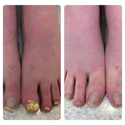 Fivfivgo™ BeeVenom Nagelpilz Lösung