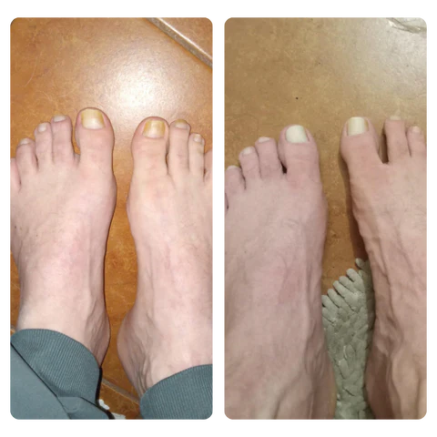 Fivfivgo™ BeeVenom Nagelpilz Lösung