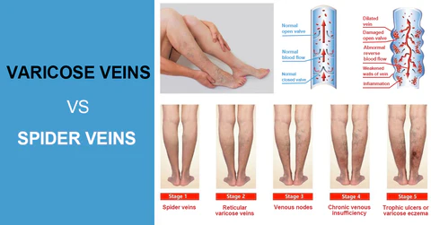Fivfivgo™ Krampfadern Behandlung Creme
