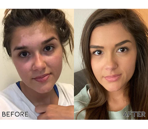 Fivfivgo™ Squalene Vitiligo-Behandlung Creme