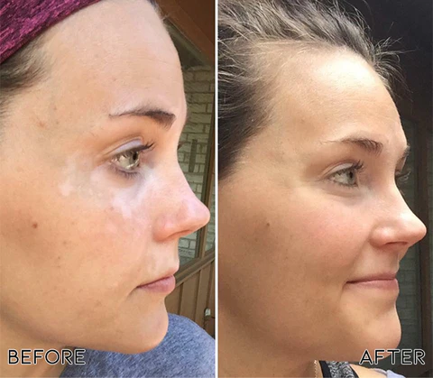 Fivfivgo™ Squalene Vitiligo-Behandlung Creme