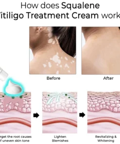 Fivfivgo™ Squalene Vitiligo-Behandlung Creme
