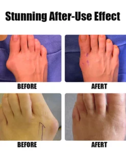 FlexBun™ Adjustable Painless Bunion Splint Corrector