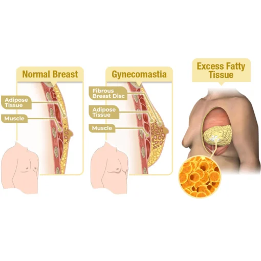 Furzero™ MenRobust Bee Venom Gynecomastia Varmeolie